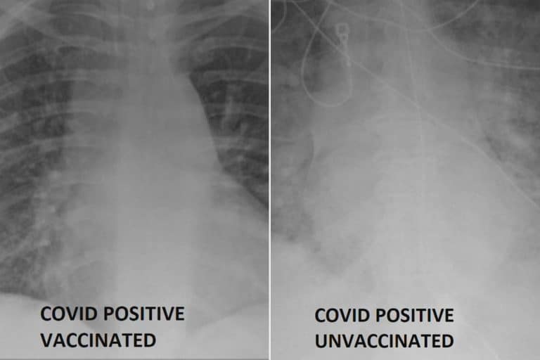 Diferențe uriaşe între plămânii pacienților infectați cu coronavirus nevaccinați/ Heatlth